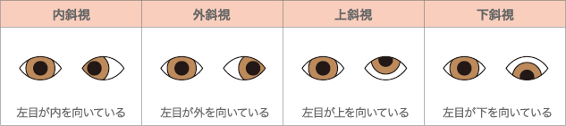 右目を正常な位置とした斜視の種類